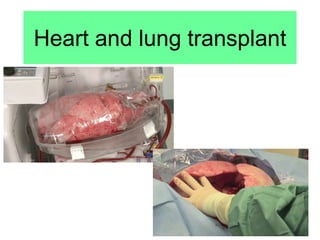 Heart and lung transplant
 