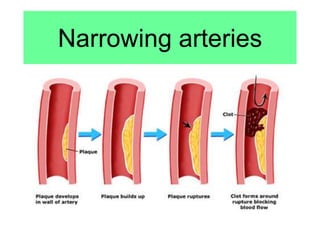 Narrowing arteries
 