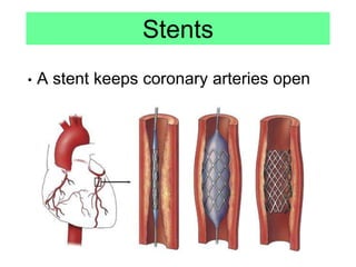 Stents
• A stent keeps coronary arteries open
 