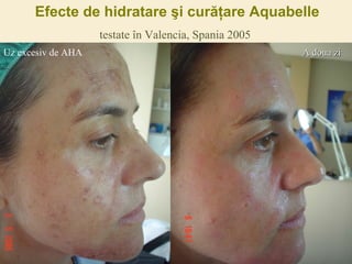 Efecte de hidratare şi curăţare Aquabelle testate în Valencia, Spania 2005 Uz excesiv de AHA A doua zi 