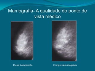 Mamografia- A qualidade do ponto de
           vista médico




  Pouca Compressão   Compressão Adequada
 