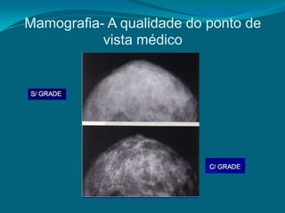 Mamografia- A qualidade do ponto de
           vista médico
 