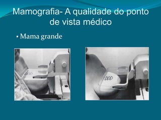 Mamografia- A qualidade do ponto
       de vista médico
 Mama grande
 