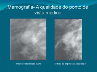 Mamografia- A qualidade do ponto de
           vista médico




  Tempo de exposição baixo   Tempo de exposição adequado
 
