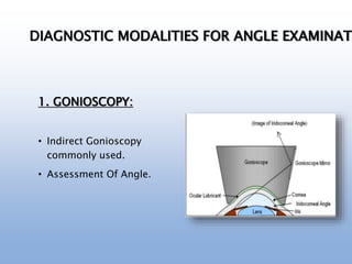 1. GONIOSCOPY:
• Indirect Gonioscopy
commonly used.
• Assessment Of Angle.
DIAGNOSTIC MODALITIES FOR ANGLE EXAMINATI
 