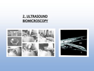 2. ULTRASOUND
BIOMICROSCOPY
 