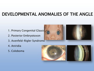 DEVELOPMENTAL ANOMALIES OF THE ANGLE
1. Primary Congenital Glaucoma
2. Posterior Embryotoxon
3. Axenfeld-Rigler Syndrome
4. Aniridia
5. Coloboma
 