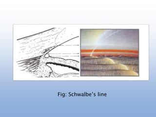 Fig: Schwalbe’s line
 