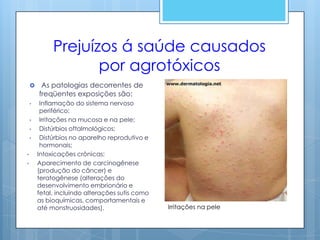 Prejuízos á saúde causados
                    por agrotóxicos
        As patologias decorrentes de
        freqüentes exposições são:
    •    Inflamação do sistema nervoso
         periférico;
    •    Irritações na mucosa e na pele;
    •    Distúrbios oftalmológicos;
    •    Distúrbios no aparelho reprodutivo e
         hormonais;
•       Intoxicações crônicas;
•       Aparecimento de carcinogênese
        (produção do câncer) e
        teratogênese (alterações do
        desenvolvimento embrionário e
        fetal, incluindo alterações sutis como
        as bioquímicas, comportamentais e
        até monstruosidades).                    Irritações na pele
 