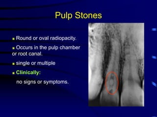 Pulpstone Radiograph Acquired abnormalities of the jaws | PPT