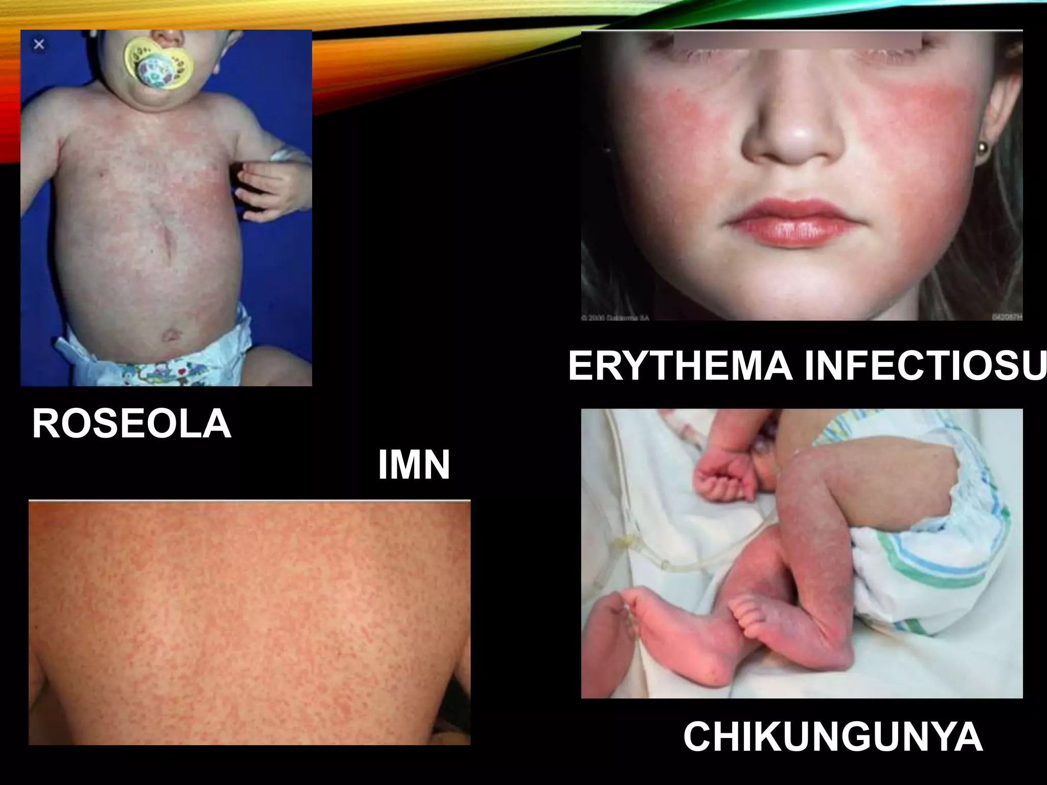 Approach to a child with fever and rash | PPTX
