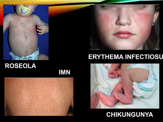 Approach to a child with fever and rash | PPTX