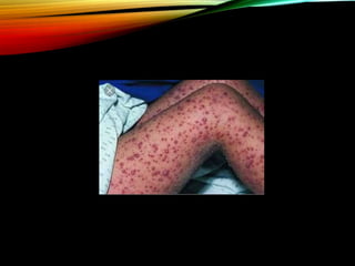 Approach to a child with fever and rash | PPTX