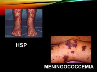 Approach to a child with fever and rash | PPTX