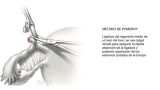 Pomeroy Method Metodos permanentes de esterilización en pareja | PDF