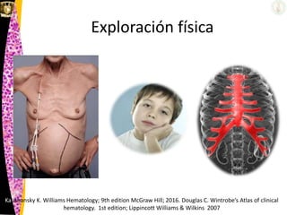 Exploración física
Kaushansky K. Williams Hematology; 9th edition McGraw Hill; 2016. Douglas C. Wintrobe’s Atlas of clinical
hematology. 1st edition; Lippincott Williams & Wilkins 2007
 