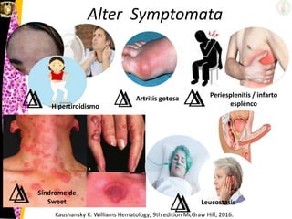 Alter Symptomata
Hipertiroidismo
Kaushansky K. Williams Hematology; 9th edition McGraw Hill; 2016.
Periesplenitis / infarto
esplénco
Leucostasis
Artritis gotosa
Síndrome de
Sweet
 