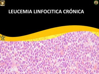 LEUCEMIA LINFOCITICA CRÓNICA
 