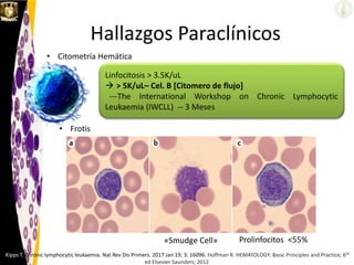 Linfocitosis > 3.5K/uL
 > 5K/uL– Cel. B [Citomero de flujo]
---The International Workshop on Chronic Lymphocytic
Leukaemia (IWCLL) -- 3 Meses
Hallazgos Paraclínicos
Kipps T. Chronic lymphocytic leukaemia. Nat Rev Dis Primers. 2017 Jan 19; 3: 16096. Hoffman R. HEMATOLOGY: Basic Principles and Practice; 6th
ed Elsevier Saunders; 2012
• Citometría Hemática
• Frotis
«Smudge Cell» Prolinfocitos <55%
 