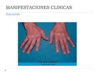 MANIFESTACIONES CLINICASSecuelas 