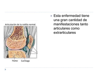 Estaenfermedadtieneunagrancantidad de manifestacionestanto articulares como extrarticulares