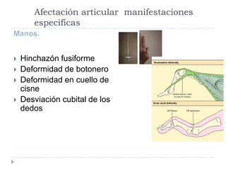 Afectación articular  manifestaciones especificasManos.Hinchazón fusiformeDeformidad de botoneroDeformidad en cuello de cisneDesviación cubital de los dedos   