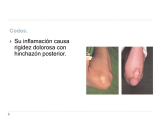 Codos. Su inflamación causa rigidez dolorosa con hinchazón posterior.