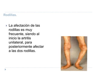Rodillas. La afectación de las rodillas es muy frecuente, siendo al inicio la artritis unilateral, para posteriormente afectar a las dos rodillas.