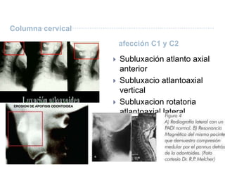 Columna cervical  afección C1 y C2Subluxación atlanto axial anteriorSubluxacioatlantoaxial vertical Subluxacion rotatoria atlantoaxial lateral