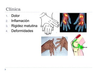 Clínica DolorInflamaciónRigidez matutinaDeformidades