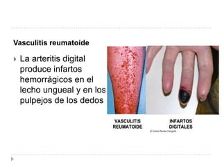Vasculitis reumatoide La arteritis digital produce infartos hemorrágicos en el lecho ungueal y en los pulpejos de los dedos