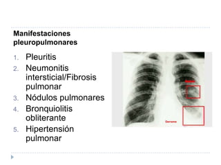 Manifestaciones pleuropulmonaresPleuritisNeumonitis intersticial/Fibrosis pulmonarNódulos pulmonaresBronquiolitis obliteranteHipertensión pulmonar