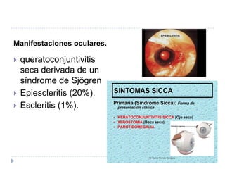 Manifestaciones oculares.queratoconjuntivitis seca derivada de un síndrome de SjögrenEpiescleritis (20%). Escleritis (1%). 