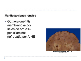 Manifestaciones renalesGomerulonefritis membranosa por sales de oro o D-penicilamina; nefropatía por AINE 