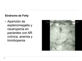 Síndrome de FeltyAparición de esplenomegalia y neutropenia en pacientes con AR crónica, anemia y trombopenia