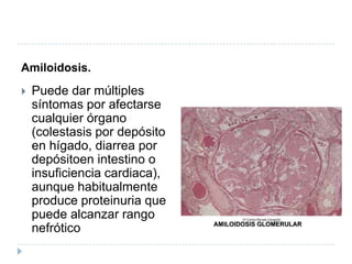 Amiloidosis. Puede dar múltiples síntomas por afectarse cualquier órgano (colestasis por depósito en hígado, diarrea por depósitoen intestino o insuficiencia cardiaca), aunque habitualmente produce proteinuria que puede alcanzar rango nefrótico