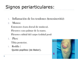 Signos periarticulares:Inflamación de los tendones (tenosinovitis):Manos:     Extensores (cara dorsal de muñeca).      Flexores: cara palmar de la mano.      Flexores cubital del carpo (cubital post)Pies:     Tibia posterior.Rodilla :     Quiste poplíteo (de Baker).