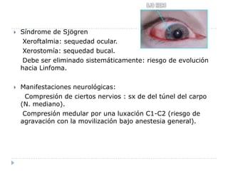 Síndrome de Sjögren      Xeroftalmia: sequedad ocular.    Xerostomía: sequedad bucal.    Debe ser eliminado sistemáticamente: riesgo de evolución hacia Linfoma.Manifestaciones neurológicas:Compresión de ciertos nervios : sx de del túnel del carpo (N. mediano).    Compresión medular por una luxación C1-C2 (riesgo de agravación con la movilización bajo anestesia general).