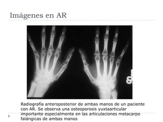 Imágenes en ARRadiografía anteroposterior de ambas manos de un paciente con AR. Se observa una osteoporosis yuxtaarticular importante especialmente en las articulaciones metacarpo falángicas de ambas manos