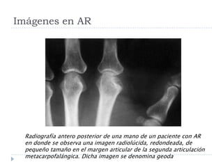 Imágenes en AR Radiografía antero posterior de una mano de un paciente con AR en donde se observa una imagen radiolúcida, redondeada, de pequeño tamaño en el margen articular de la segunda articulación metacarpofalángica. Dicha imagen se denomina geoda