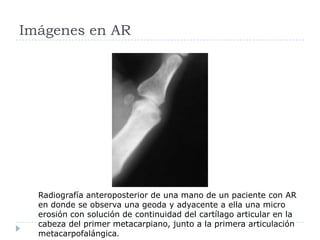 Imágenes en AR Radiografía anteroposterior de una mano de un paciente con AR en donde se observa una geoda y adyacente a ella una micro erosión con solución de continuidad del cartílago articular en la cabeza del primer metacarpiano, junto a la primera articulación metacarpofalángica.