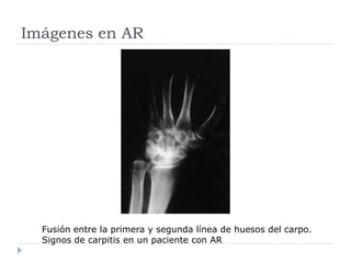 Imágenes en AR Fusión entre la primera y segunda línea de huesos del carpo. Signos de carpitis en un paciente con AR
