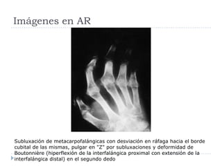 Imágenes en ARSubluxación de metacarpofalángicas con desviación en ráfaga hacia el borde cubital de las mismas, pulgar en "Z" por subluxaciones y deformidad de Boutonnière (hiperflexión de la interfalángica proximal con extensión de la interfalángica distal) en el segundo dedo