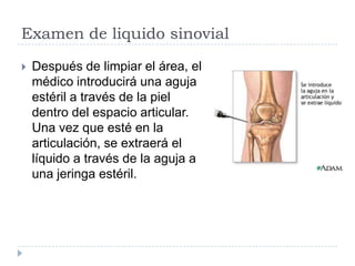 Examen de liquido sinovialDespués de limpiar el área, el médico introducirá una aguja estéril a través de la piel dentro del espacio articular. Una vez que esté en la articulación, se extraerá el líquido a través de la aguja a una jeringa estéril.
