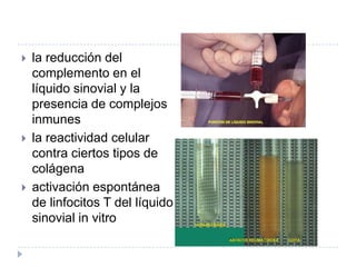 la reducción del complemento en el líquido sinovial y la presencia de complejos inmunes la reactividad celular contra ciertos tipos de colágenaactivación espontánea de linfocitos T del líquido sinovial in vitro