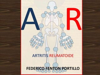 ARTRITIS REUMATOIDE

FEDERICO FENTON PORTILLO
 