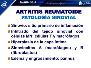 Sinovio: sitio primario de inflamación
Infiltrado del tejido sinovial con
células MN: células T y macrófagos
Hiperplasia de la capa íntima
Sinoviocitos A (macrófagos) y B
(fibroblastos)
Edema y engrosamiento: pannus
ARTRITIS REUMATOIDE
PATOLOGÍA SINOVIAL
 