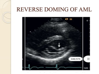 REVERSE DOMING OF AML
 
