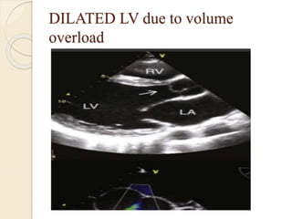 DILATED LV due to volume
overload
 