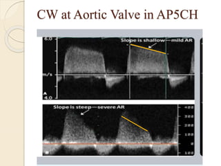 CW at Aortic Valve in AP5CH
 